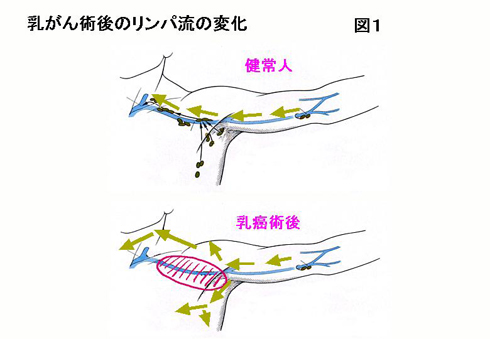 図1：乳がん術後のリンパ流の変化