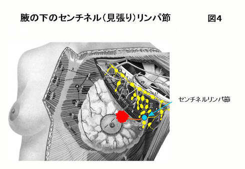 図4：腋の下のセンチネル（見張り）リンパ節