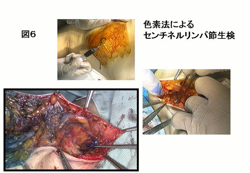 図6：色素法によるセンチネルリンパ節生検