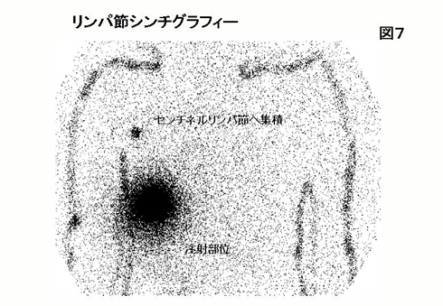 図7：リンパ節シンチグラフィー